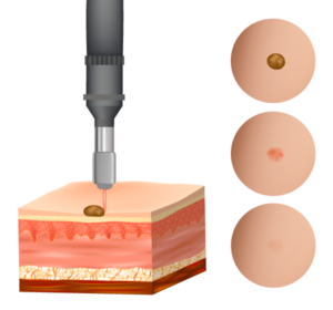 dermatologia chirurgica